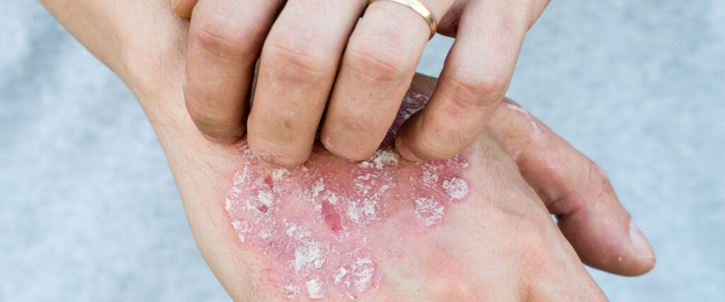 Skin rashes treatment in Express Emergency Room Abilene